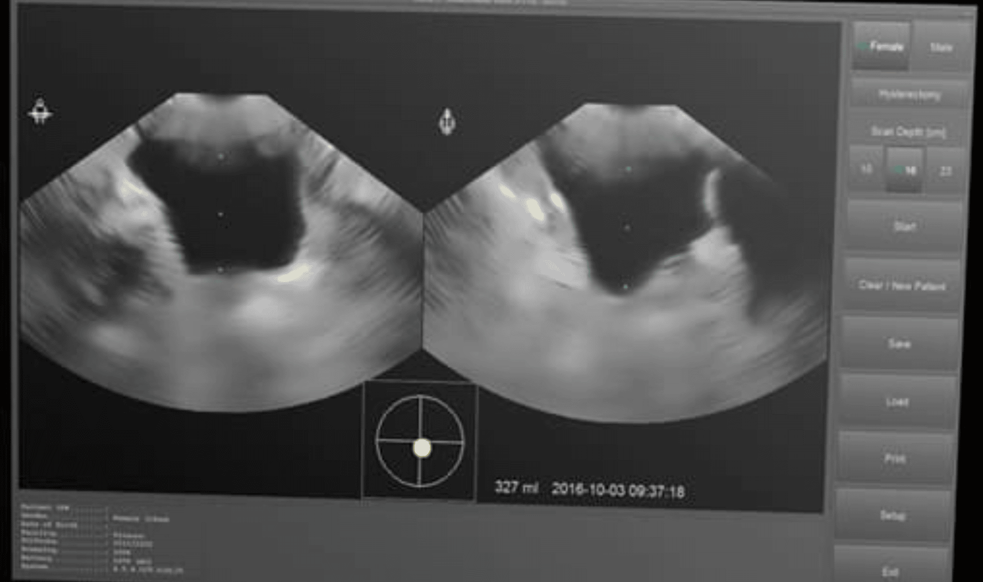 Bladder Scanner Scanner V Sical Avf Biomedical